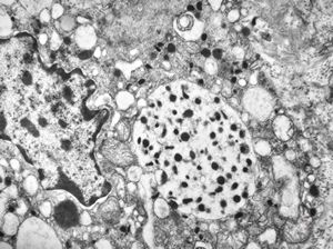 M, 38y. | pheochromocytoma M, 38y. | pheochromocytoma